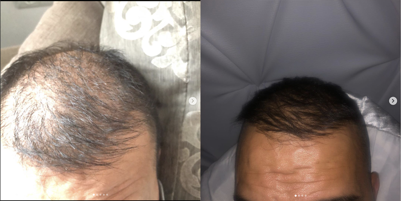 antes-depois